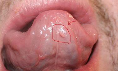 bệnh mụn cóc sinh dục ở miệng