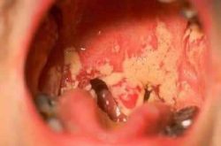 hình ảnh bệnh lậu ở miệng